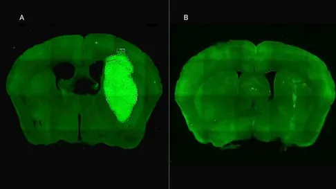 El CONICET identificó una nueva estrategia terapéutica para frenar el desarrollo del glioblastoma. El CONICET identificó una nueva estrategia terapéutica para frenar el desarrollo del glioblastoma.