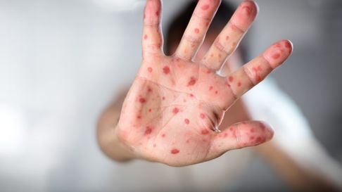 detectaron un caso de viruela de mono en la plata detectaron un caso de viruela de mono en la plata