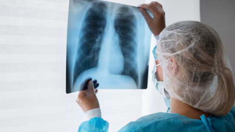 La tuberculosis preocupa al sector de salud La tuberculosis preocupa al sector de salud
