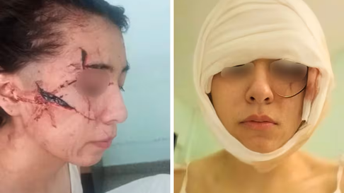 Una menor de 15 años fue brutalmenbte atacada en Santa Fe. Una menor de 15 años fue brutalmenbte atacada en Santa Fe.