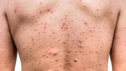 Cinco nuevos casos de viruela símica en el Gran Mendoza. Cinco nuevos casos de viruela símica en el Gran Mendoza.