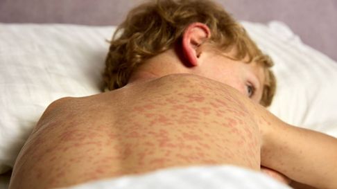 La situación por los casos de sarampión es cada vez más dificil La situación por los casos de sarampión es cada vez más dificil